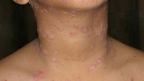  آسٹریائی ماہرین کا جلد کے چنبل کا  شافی علاج دریافت کرنے کا دعویٰ