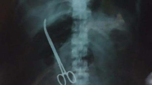 3ماہ بعد مریضہ کے پیٹ میں  رہ جانیوالی قینچی نکال لی گئی 