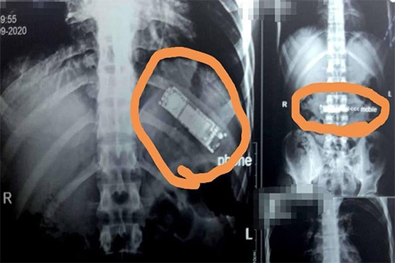 آپریشن کرکے پیٹ سے 7ماہ بعد موبائل فون نکال لیاگیا 