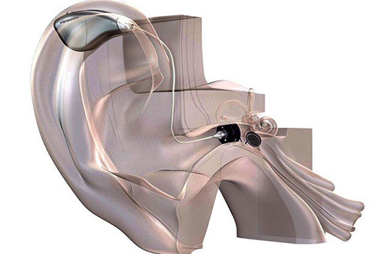 جرمنی میں کان کیلئے ‘‘کونٹیکٹ لینز’’ پیش کردیا گیا