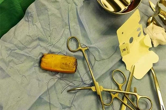  مریض کا نگلا فون ڈاکٹروں نے 6ماہ بعد پیٹ سے نکال لیا