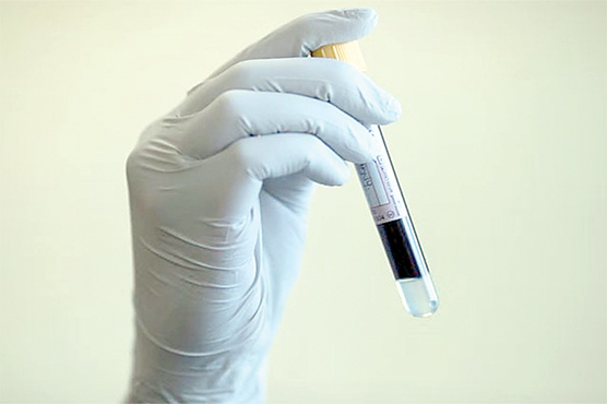 دل کے دورے کا خطرہ کم کرنے والا نیا خون کا ٹیسٹ