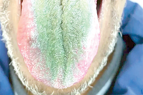 زیادہ سگریٹ پینے سے امریکی شہری کی زبان سبز ہوگئی