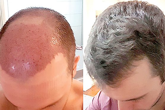 بالوں کو دوبارہ اگانے میں مددگار اہم مالیکیول دریافت 