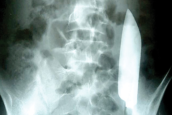 درد کی شکایت پرہسپتال جانیوالے کے پیٹ سے چاقو برآمد