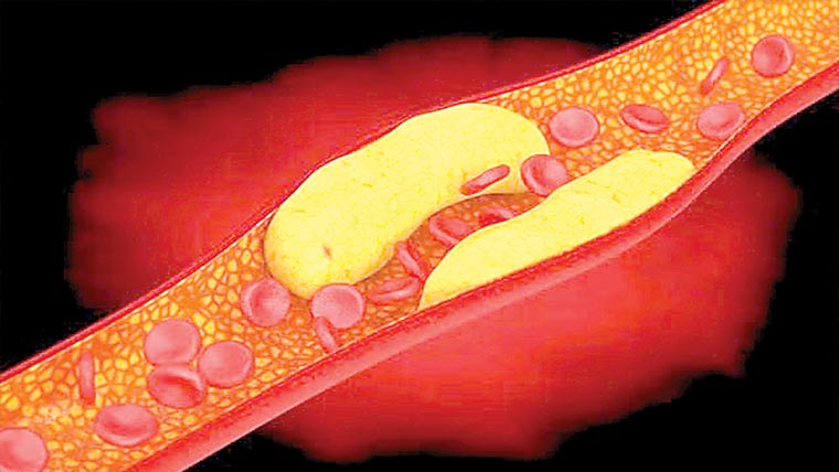 کولیسٹرول کی زیادتی قلبی مرض اور فالج کا سبب بن سکتی 