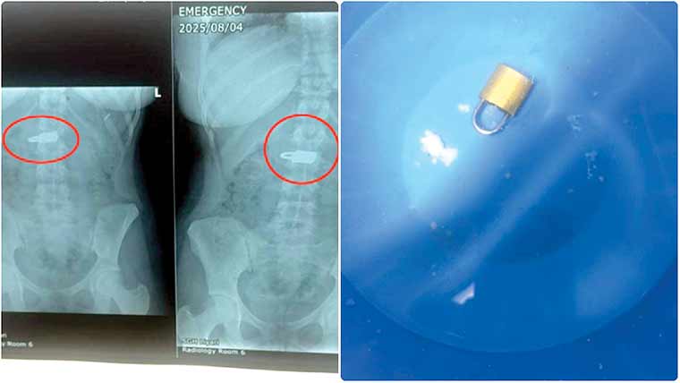 کراچی میں خاتون کے پیٹ سے بنا سرجری تالا نکال لیا گیا