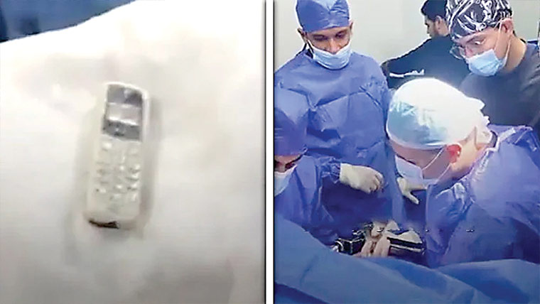 مصر ،سرجری کے بعد معدے سے موبائل فون نکال لیا