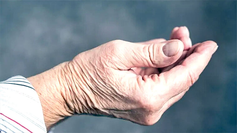 چہل قدمی کے انداز سے پارکنسن کی تشخیص ممکن:تحقیق