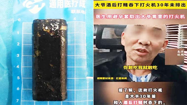 چین:فعال لائٹر شہری کے پیٹ سے 30سال بعد برآمد