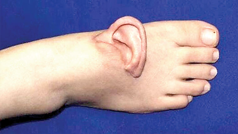  چینی خاتون کا کان کٹ گیا، ڈاکٹرز نے کان پیر میں لگادیا 