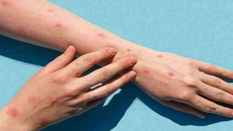 میو ہسپتال:2مریضوں میں منکی  پاکس کی تصدیق، 3 مشتبہ قرار