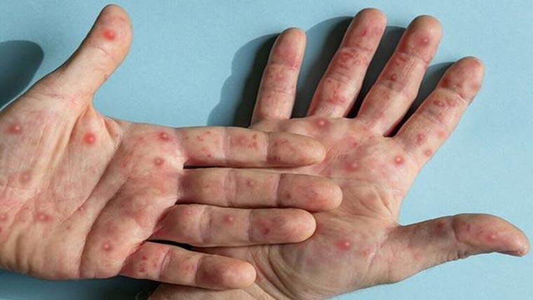 لاہور میں منکی پاکس کے مزید  دو نئے مریضوں کی تصدیق 