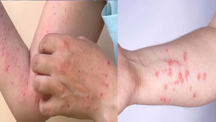 لاہور میں منکی پاکس پھیلنے لگا، 14مریضوں کی رپورٹ مثبت 