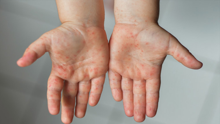  امریکا:بدترین خسرہ وبا،  1277کیسز ، 3 اموات 