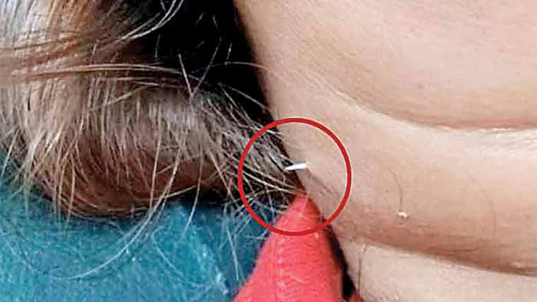  تھائی خاتون نے مچھلی کھائی، کانٹا گردن چیر کر باہر نکل آیا