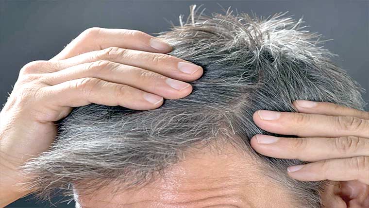 کم عمری میں بال سفید ہونے کی وجوہات سامنے آگئیں