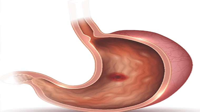 گیسٹروکے مریضوں کی تعداد میں اضافہ