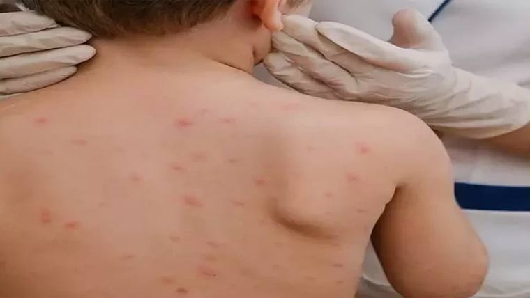 لاڑکانہ ڈویژن :رواں برس خسرے کے 400 کیس رپورٹ 