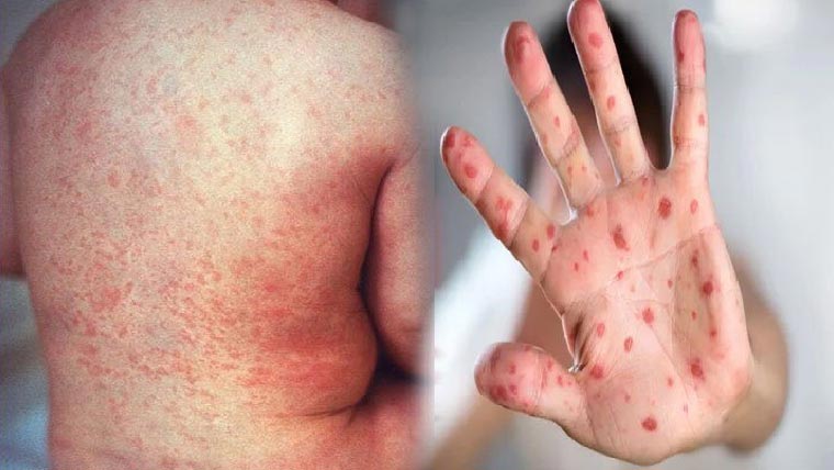 انسداد خسرہ،روبیلا مہم17نومبرسے شروع ہو گی 