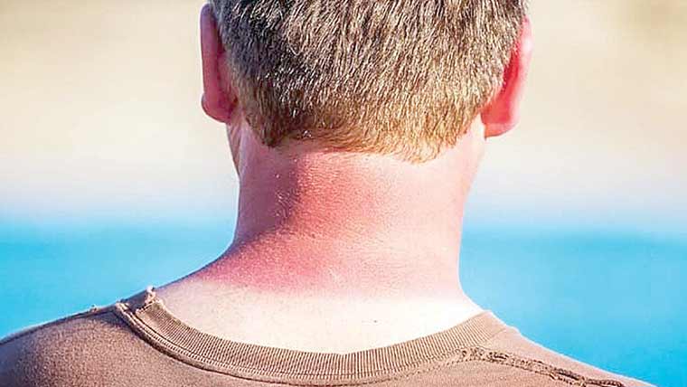 الٹرا وائلٹ شعاعیں جلد کے کینسر کا سبب بنتی ہیں:تحقیق