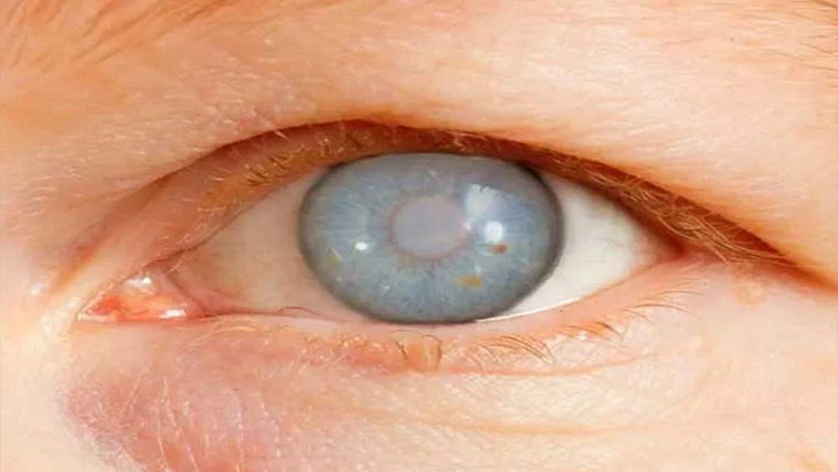 وزن گھٹانے کی ادویات سے بینائی جا سکتی ہے :تحقیق