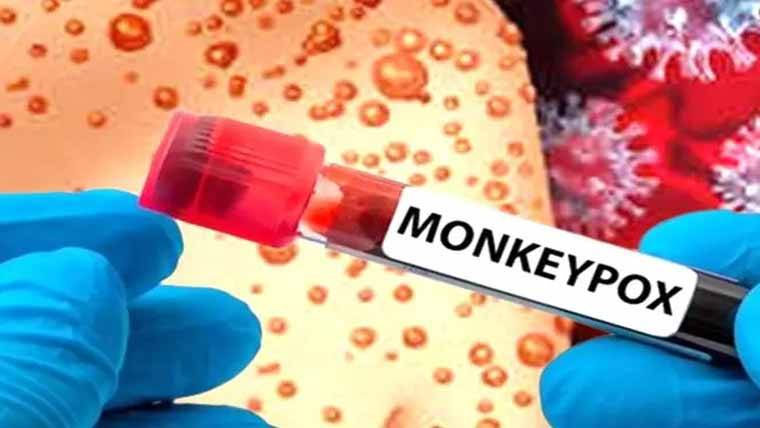 لاہور میں بھی منکی پاکس ،جنرل ہسپتال میں پہلا مریض داخل