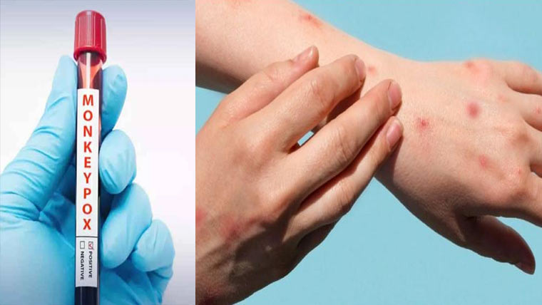 لاہوراور کراچی میں منکی پاکس کے 2 نئے کیس رپورٹ 