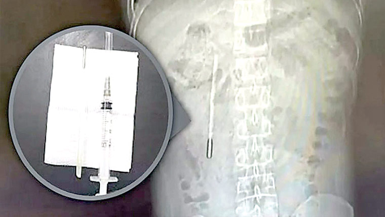  چین،پیٹ سے بچپن میں نگلا ہوا تھرمامیٹر نکال لیا گیا