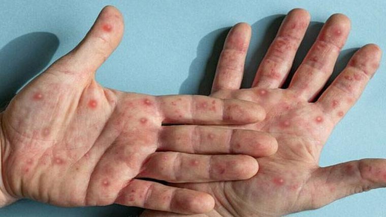 لاہور میں منکی پاکس کیسز میں  اضافہ، محکمہ ہیلتھ کا الرٹ جاری