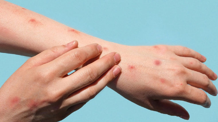 منکی پاکس کیسز میں تشویشناک اضافہ 