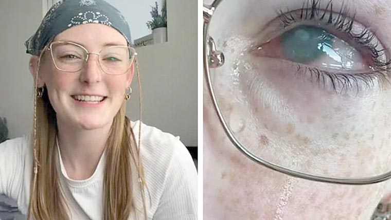  کانٹیکٹ لینز کیساتھ نہانے پرلڑکی بینائی سے محروم