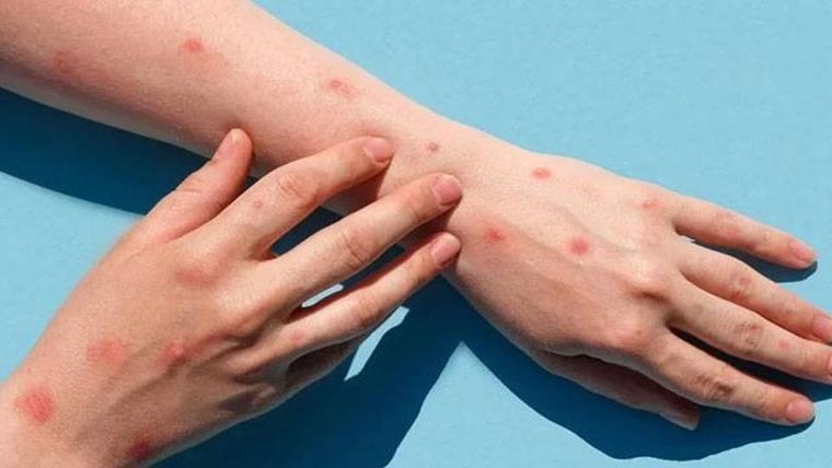 18سالہ لڑکا منکی پاکس کا شکار  لاہور میں مریضوں کی تعداد33ہوگئی