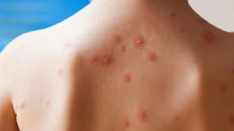 رواں سال ملک بھر میں خسرہ سے  71 اموات ،4ہزارکیسزکی تصدیق