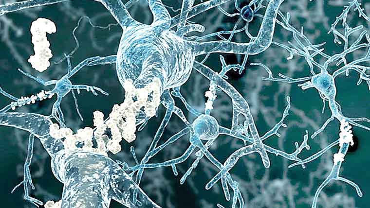 ڈوپامین کی بحالی سے الزائمرز میں یادداشت بحال ہونیکی امید