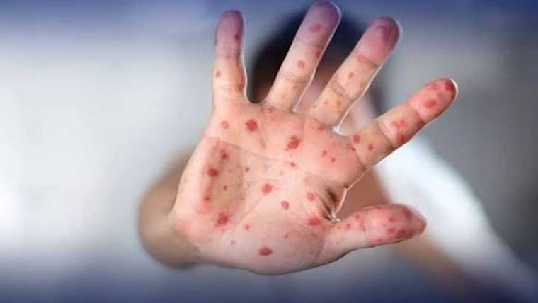 خسرہ ،پنجاب میں مریضوں کی تعداد ایک ہزار سے تجاوز 