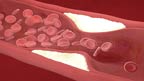 شریانوں میں جمی چکنائی کو کیسے دور کیا جا سکاتا ہے