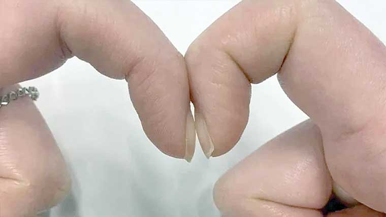 انگلیوں کا ٹیسٹ پھیپھڑوں کے کینسر کی تشخیص کر سکتا 