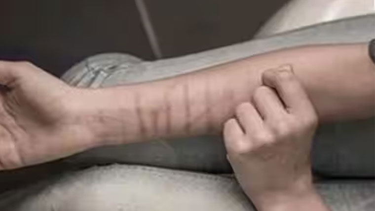  سکول طلبہ کے ہاتھوں پر پراسرار گہرے زخم کے نشانات