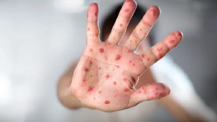 خسرہ سے ہلاکتوں کے کیس کی  سماعت، افسر ذاتی حیثیت میں طلب 