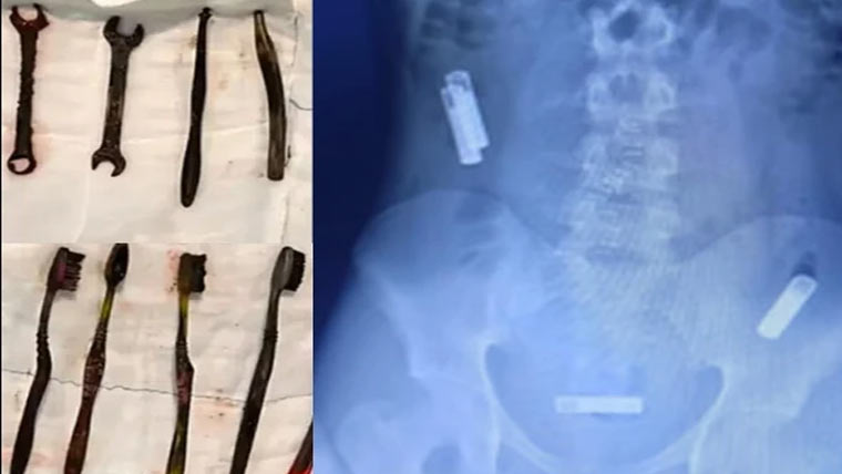 نوجوان کے معدے سے 7ٹوتھ برش اور رینچ نکل آئے 