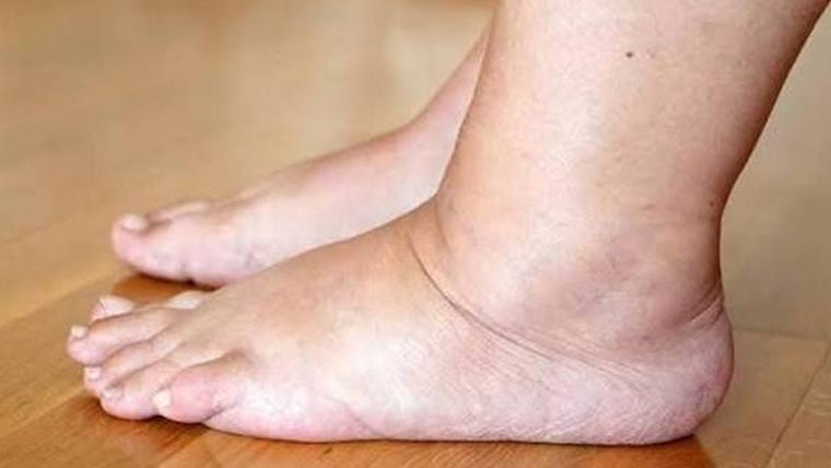  10منٹ میں پاؤں کی سوجن کم،ذہنی تناؤ سے نجات کا طریقہ 