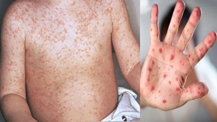 گھوٹکی:خسرہ کے باعث  دو کمسن بچے جاں بحق ہو گئے 