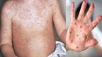 گھوٹکی:خسرہ کے باعث  دو کمسن بچے جاں بحق ہو گئے 