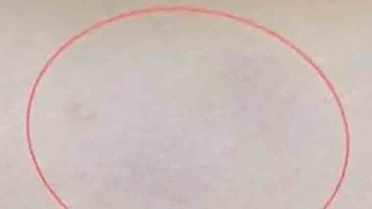 خاتون کے بازو سے 2زندہ کیڑے نکال لیے گئے