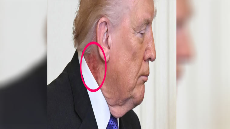  ٹرمپ کی گردن پر سرخ داغ 