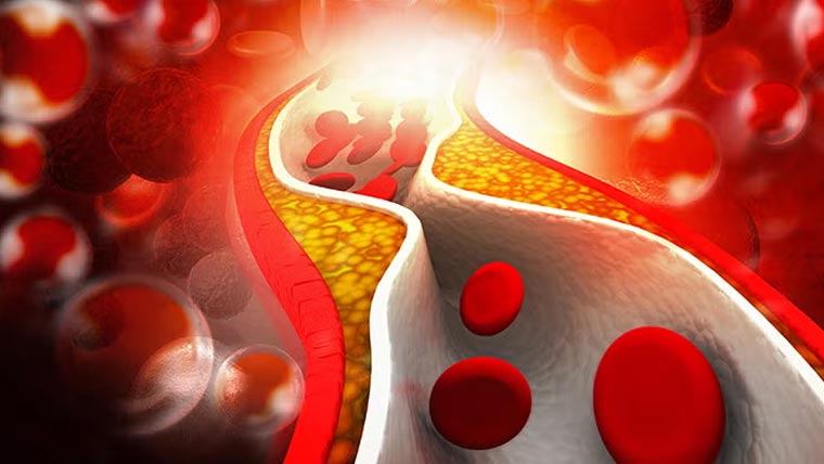 ہائی کولیسٹرول:خاموش خطرہ،بچاؤ بروقت احتیاط میں ہے