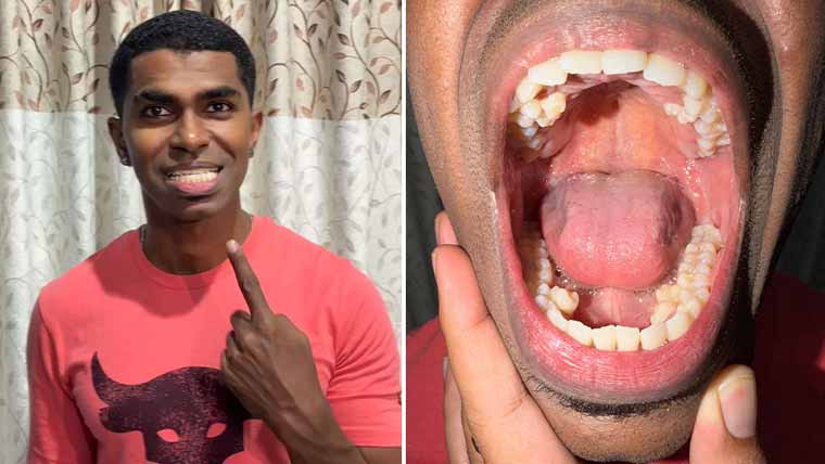 ملائشین شہری نے سب سے زیادہ 42 دانت رکھنے کا ریکارڈ 