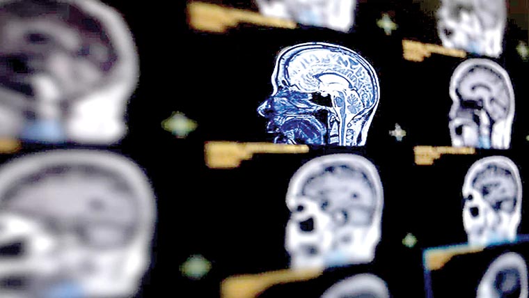 اے آئی ٹیکنالوجی سے الزائمر کی پیشگی تشخیص میں پیشرفت