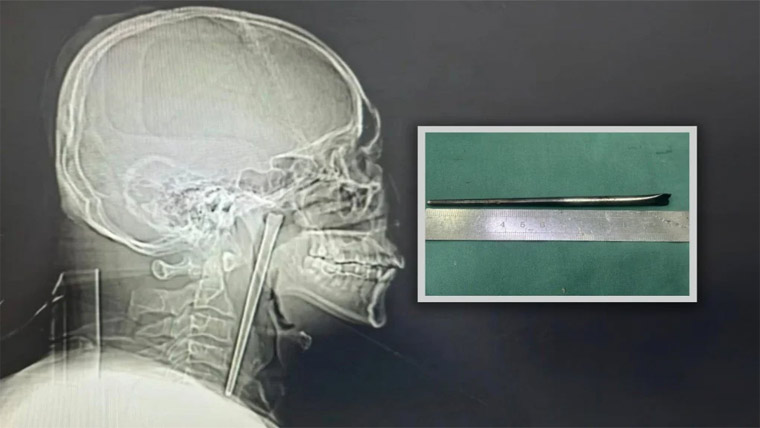 8 سال تک حلق میں چوپ سٹک پھنسا کر جینے والا شخص